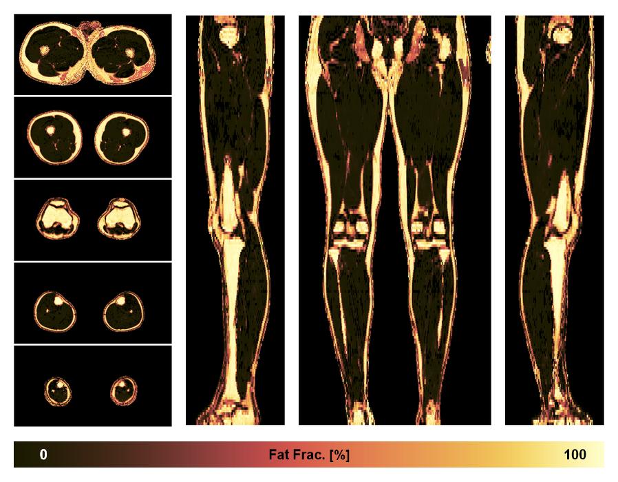 The fat fraction of the lower extremity obtained from the dixon reconstruction for muscle water fat quantification.